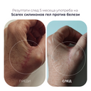 scarex силиконов гел против белези - резултати преди и след употреба